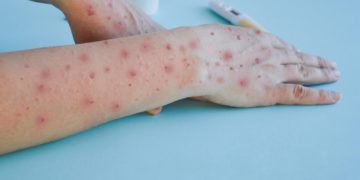Monkey pox virus, a new world problem of modern humanity. Close-up of the hands of a sick person with pimples and blisters. Smallpox vaccine.