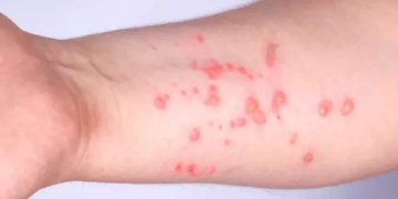 Identifican casos sospechosos de la viruela símica en Solidaridad